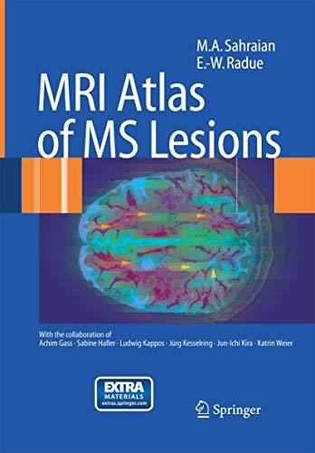 MRI Atlas of MS Lesions