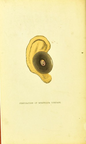 Diseases of the ear