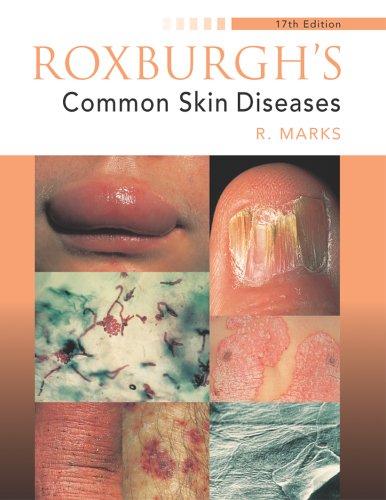 Roxburgh's Common Skin Diseases (Medicine)
