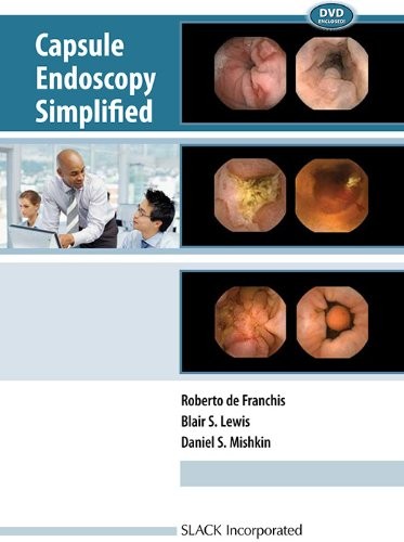Capsule endoscopy simplified