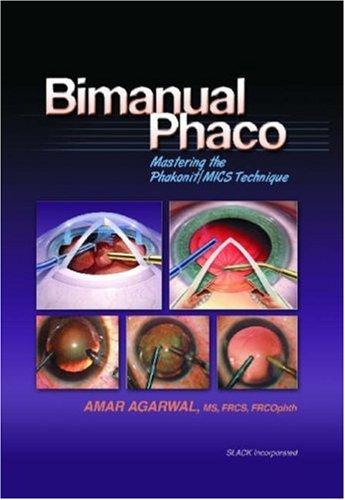 Bimanual Phaco