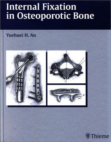 Internal Fixation In Osteoporotic Bone