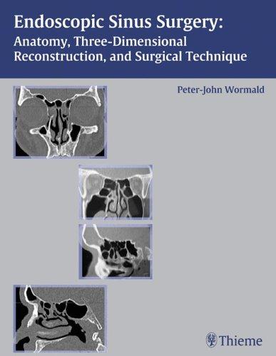 Endoscopic sinus surgery