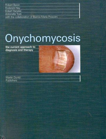Onychomycosis