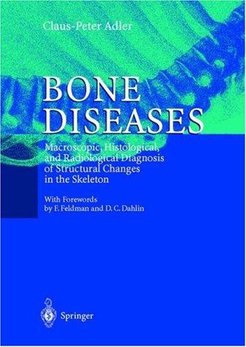 Bone Diseases