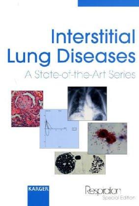 Interstitial Lung Diseases