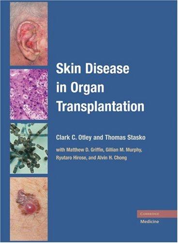 Skin disease in organ transplantation