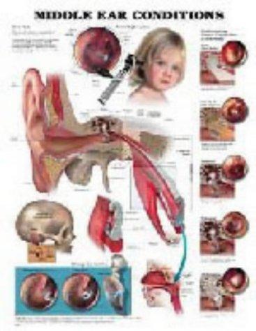 Middle Ear Conditions Anatomical Chart