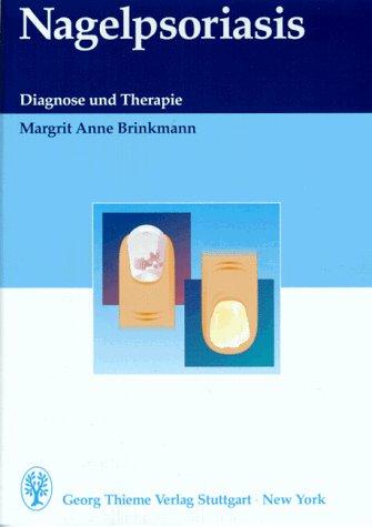 Nagelpsoriasis. Diagnose und Therapie