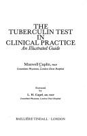 The tuberculin test in clinical practice