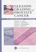 Gleason grading of prostate cancer