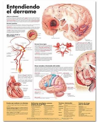 Understanding Stroke Anatomical Chart in Spanish Entendiendo Que Es Un Derrame