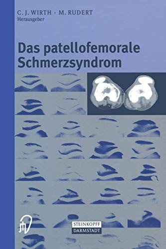 Das patellofemorale Schmerzsyndrom